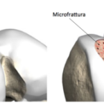 300x126xmicrofratture.png.pagespeed.ic_.xOvmMD1WPk