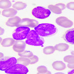 Leucemia-Acuta-Promielocitica