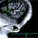 adhd-genetic-disorder-evidence