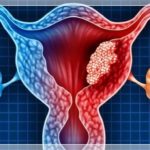 cancro-ovarico-114030.660x368