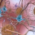 5360301_1013_alzheimer