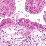 Mucinous_lmp_ovarian_tumour_intermed_mag