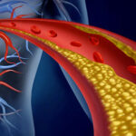 Rischi-del-colesterolo