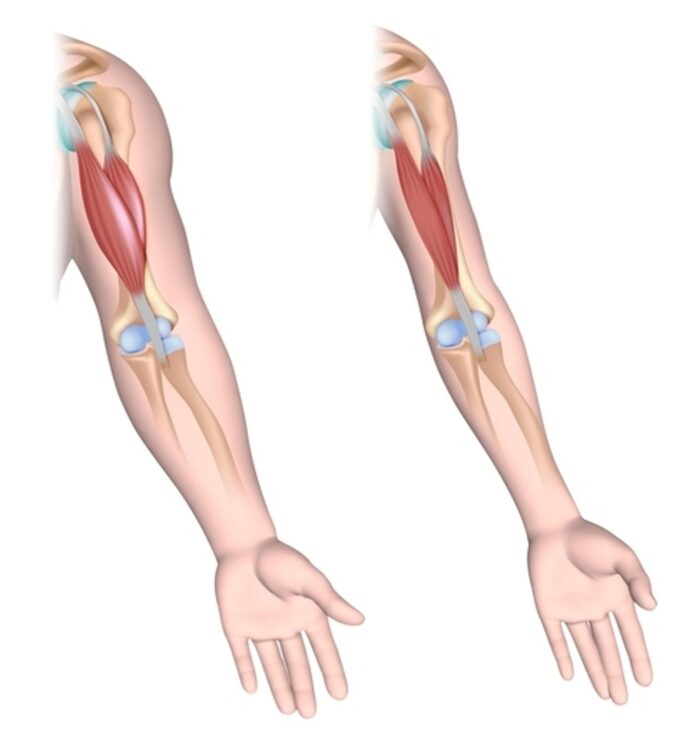 Distrofia muscolare di Duchenne nuovo farmaco