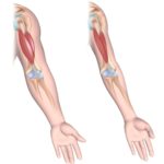 dystrophic-arm-muscle