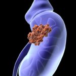 immagine-di-cancro-al-rene-768x1024