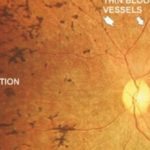 ottica-maura-articolo-retinite-pigmentosa-1170x658