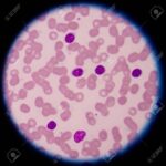 Chronic lymphocytic leukemia (CLL) is a type of cancer of the bl