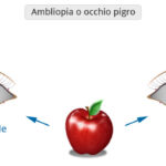 Ambliopia_Occhio_Pigro_Poliambulanza