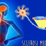 Sclerosi-multipla-1 (1)