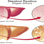 Steatosi-ep