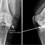 artrosi_osso_su_osso