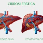 fegato-sano-e-con-cirrosi