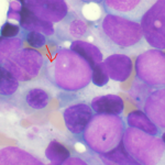 myeloidleuke (1)
