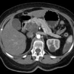 pancreaticca