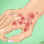 v4-460px-Diagnose-Discoid-Lupus-Step-1-Version-2