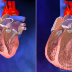 3850378299001_4818688185001_098-CongestiveHeartFailure