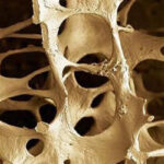 osteoporosi-dettaglio