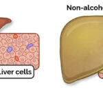 Fatty-Liver-Disease-in-Kids-1 (1)