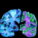 c0123811-alzheimer_s_disease-spl-2