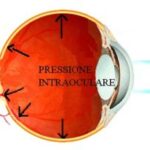 glaucoma-immagine_pressione_intraoculare-300x205