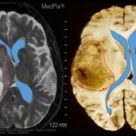 glioblastoma_examples