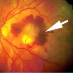 maculopatia_senile-320x271