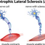 sla-sclerosi-laterale-amiotrofica