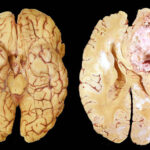 Glioblastoma