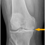 Gonartrosi