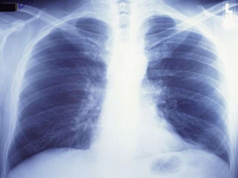 Fibrosi polmonare un'altra malattia mortale per i fumatori MediMagazine