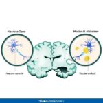 content_alzheimer-placche-amiloidi