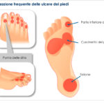 piedeDiabetico