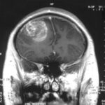1-glioblastoma