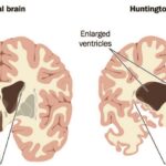 Huntingtons Disease-01