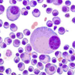 Mieloma_multiplo (1)