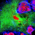 neuroblastoma_thumb_720_480 (1)