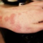 orticaria-allergia
