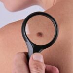 prevenire-il-melanoma-quali-sono-i-controlli-da-fare-1000-1000