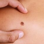 tumore-alla-pelle-cancro10