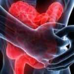 Colite-ulcerosa-o3t1ajngw8b1bhcxsvb9zcqi2r4iyuok8l4i6231ps