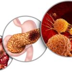 Pancreas Cancer Anatomy