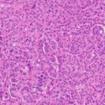 lungcancerre