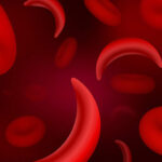 sickle-cell-877x470
