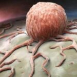 tumori-kmDB-U3000997840772Xz-593x443@Corriere-Web-Sezioni