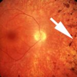 Retinopatia_pigmentosa-1-1200x876