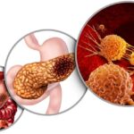 Pancreas Cancer Anatomy