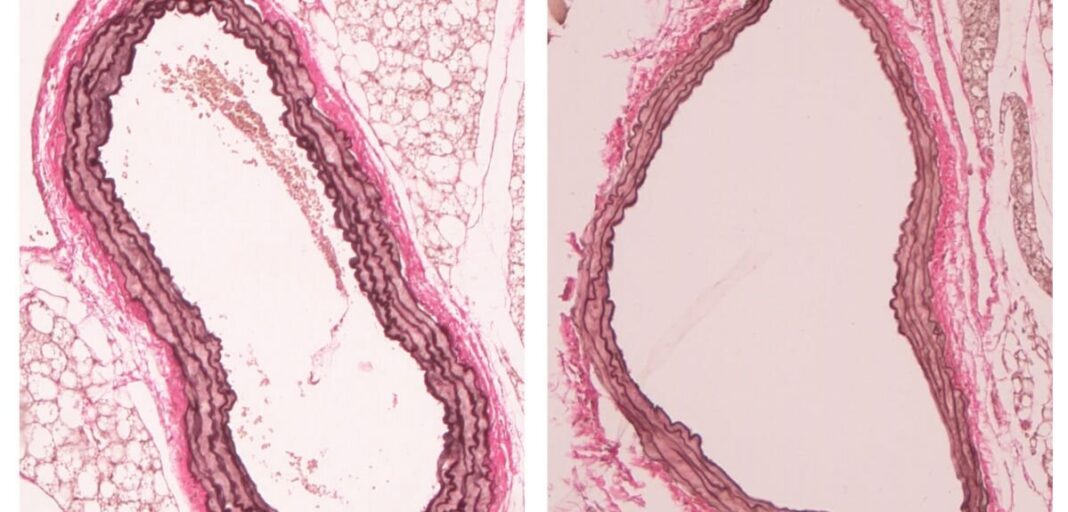 Aneurisma dell'aorta addominale individuato nuovo target MediMagazine