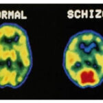schizofrenia-dsm-5-psicosi