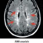 sclerosi-multipla-rmn-encefalo